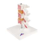 Modelo de osteoporosis &ndash; Versi&oacute;n de Lujo (3 Vertebrales), 1000153 [A78], Modelos de v&eacute;rtebras (Small)