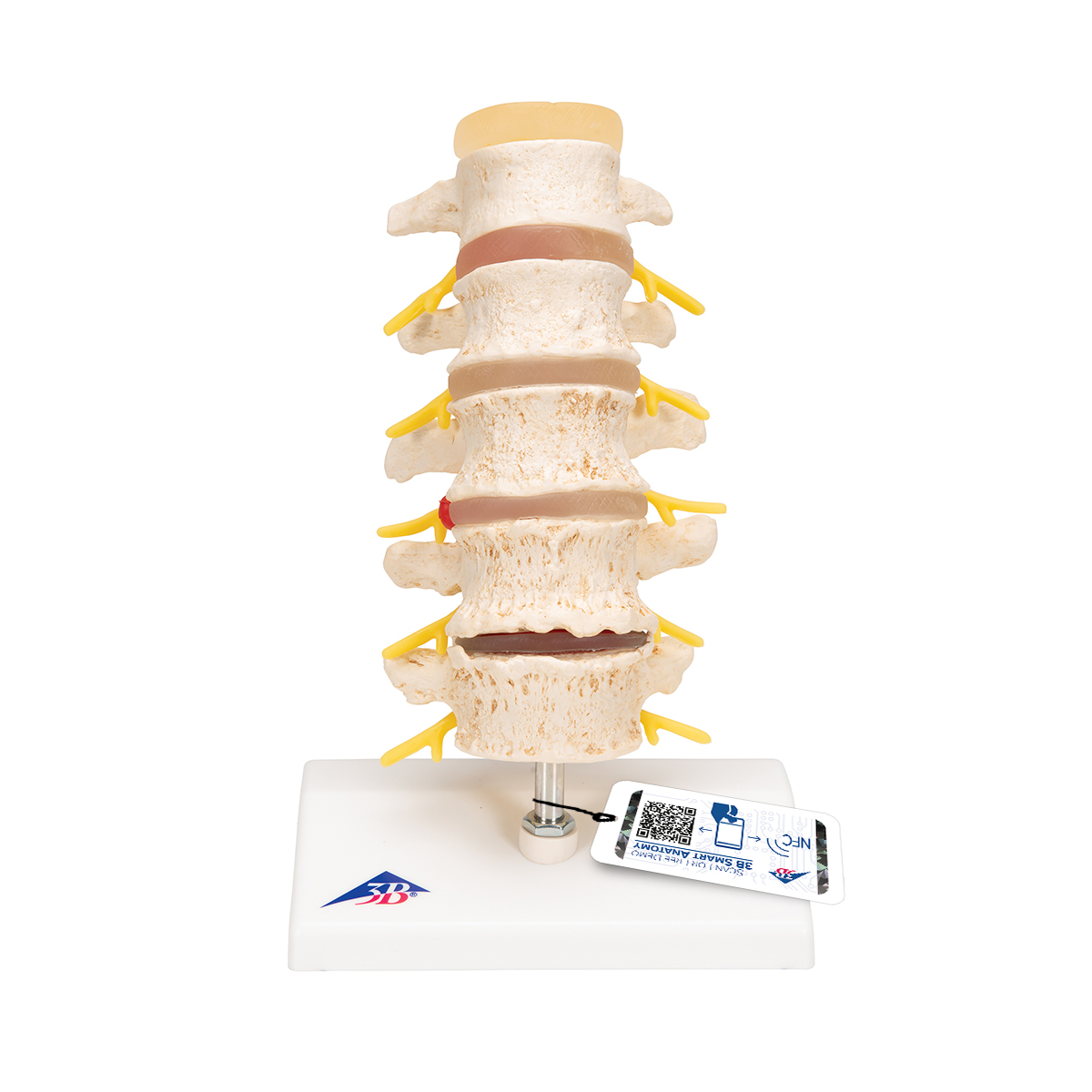 13.4 Height 3B Scientific A76/5 Lumbar Spinal Column with Dorso-Lateral Prolapsed Intervertebral Disc