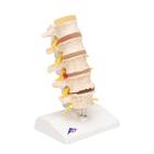 퇴행성 요추와 추간판탈출증 모형 Stages of disc prolapse and vertebral degeneration, 1000158 [A795], 척추뼈 모형 (Small)