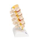 퇴행성 요추와 추간판탈출증 모형 Stages of disc prolapse and vertebral degeneration, 1000158 [A795], 척추뼈 모형 (Small)