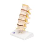 Stages of Disc Prolapse and Vertebral Degeneration, 1000158 [A795], Vertebra Models (Small)