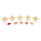 Stages of Disc Prolapse and Vertebral Degeneration, 1000158 [A795], Vertebra Models (Small)