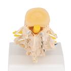 Stages of Disc Prolapse and Vertebral Degeneration, 1000158 [A795], Vertebra Models (Small)