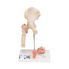 Модель перелома бедренной кости и остеоартрита тазобедренного сустава - 3B Smart Anatomy, 1000175 [A88], Артрит и остеопороз