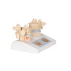 Osteoporosis Didactic Model, 1000182 [A95], Human Spine Models (Small)