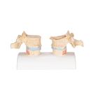 Osteoporosis Didactic Model, 1000182 [A95], Human Spine Models (Small)