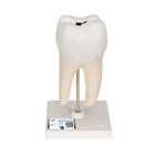 下颌双根臼齿显龋部位，2部分 - 3B Smart Anatomy, 1000243 [D10/4], 牙齿模型