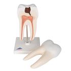 Lower Twin-Root Molar with Cavities Human Tooth Model, 2 part, 1000243 [D10/4], Dental Models (Small)