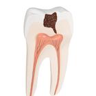Lower Twin-Root Molar with Cavities Human Tooth Model, 2 part, 1000243 [D10/4], Dental Models (Small)
