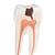 Dente molare inferiore a due radici, con carie, in 2 parti - 3B Smart Anatomy, 1000243 [D10/4], Modelli Dentali (Small)