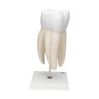 Giant Molar with Dental Cavities Human Tooth Model, 15 times Life-Size, 6 part, 1013215 [D15], Dental Models (Small)