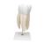 Giant Molar with Dental Cavities Human Tooth Model, 15 times Life-Size, 6 part - 3B Smart Anatomy, 1013215 [D15], Dental Models (Small)