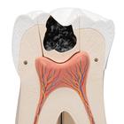 Giant Molar with Dental Cavities Human Tooth Model, 15 times Life-Size, 6 part, 1013215 [D15], Dental Models (Small)