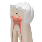 Giant Molar with Dental Cavities Human Tooth Model, 15 times Life-Size, 6 part, 1013215 [D15], Dental Models (Small)