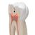 Гигантская модель моляра, пораженного кариесом, 15-кратное увеличение, 6 частей - 3B Smart Anatomy, 1013215 [D15], Модели зубов (Small)