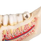 Dental Disease Model, Magnified 2 times, 21 parts, 1000016 [D26], Dental Models (Small)
