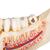 牙病模型，2倍放大，21个部分 - 3B Smart Anatomy, 1000016 [D26], 牙齿模型 (Small)