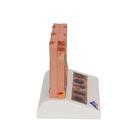 Skin Cancer Model with 5 stages, 8 times magnified, 1000293 [J15], Skin Models (Small)