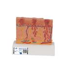 Skin Cancer Model with 5 stages, 8 times magnified, 1000293 [J15], Skin Models (Small)