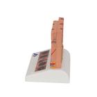 Skin Cancer Model with 5 stages, 8 times magnified, 1000293 [J15], Skin Models (Small)