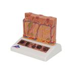 Skin Cancer Model with 5 stages, 8 times magnified, 1000293 [J15], Skin Models (Small)