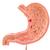 Estomac avec ulcères gastriques - 3B Smart Anatomy, 1000304 [K17], Modèles de systèmes digestifs (Small)