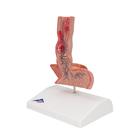 Модель болезней пищевода, 1000305 [K18], Модели пищеварительной системы человека (Small)