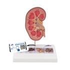 신장결석 모형
Kidney Stone Model - 3B Smart Anatomy, 1000316 [K29], 비뇨기계 모형