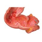 Intestinal Diseases Model, 1008496 [K55], Digestive System Models (Small)