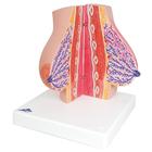 Model of Female Breast with Healthy & Unhealthy Tissue, 1008497 [L56], Breast Models (Small)