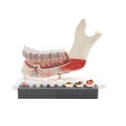 Comprehensive Lower Jaw Model (Left Half) with Diseased Teeth, Nerves, Vessels & Glands, 19 part, 1001250 [VE290], Dental Models (Small)