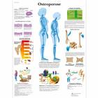 Lehrtafel - Osteoporose, 4006570 [VR0121UU], Arthritis und Osteoporose