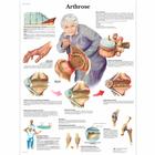 Arthrose, 1001308 [VR0123L], Arthritis and Osteoporosis Education