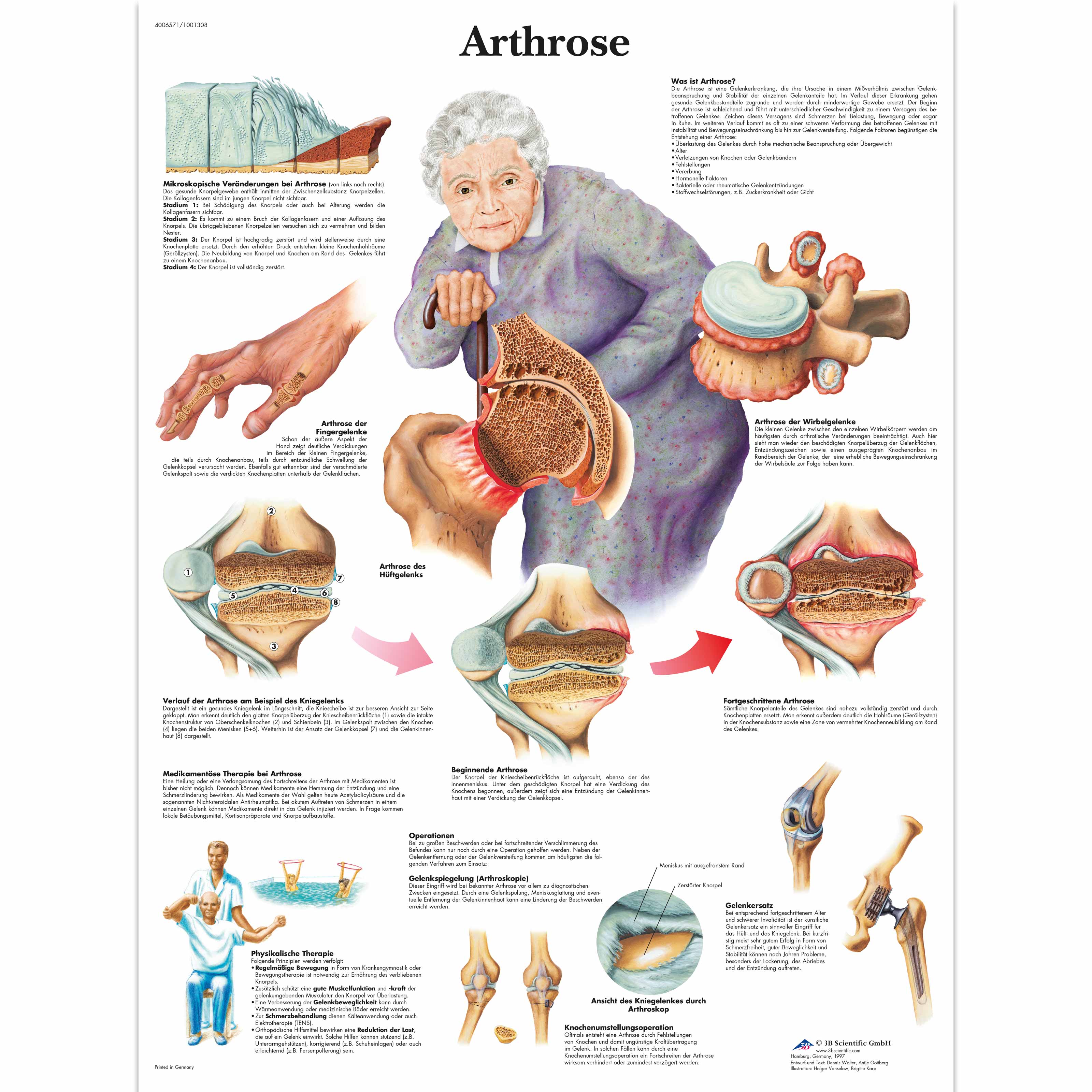 Arthrose 4006571 3b Scientific Vr0123uu Arthritis Patient Education Arthritis Models 