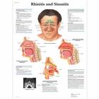 Lehrtafel - Rhinitis und Sinusitis, 1001338 [VR0251L], Hals, Nasen und Ohren (HNO)