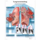 Lungenentzündung, 1001352 [VR0326L], Parasitic, Viral or Bacterial Infection