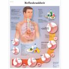 Refluxkrankheit, 1001440 [VR0711L], Digestive System
