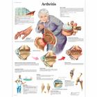 Lehrtafel - Arthritis, 1001474 [VR1123L], Arthritis und Osteoporose