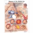 Diseases of the Middle Ear, 1001506 [VR1252L], Fül, orr, gége