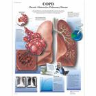 Lehrtafel - COPD Chronic Obstructive Pulmonary Disease, 1001522 [VR1329L], Atmungssystem