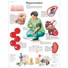 高血压挂图, 1001532 [VR1361L], 心血管系统