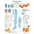 Varicose Veins Chart, 1001534 [VR1367L], Cardiovascular System