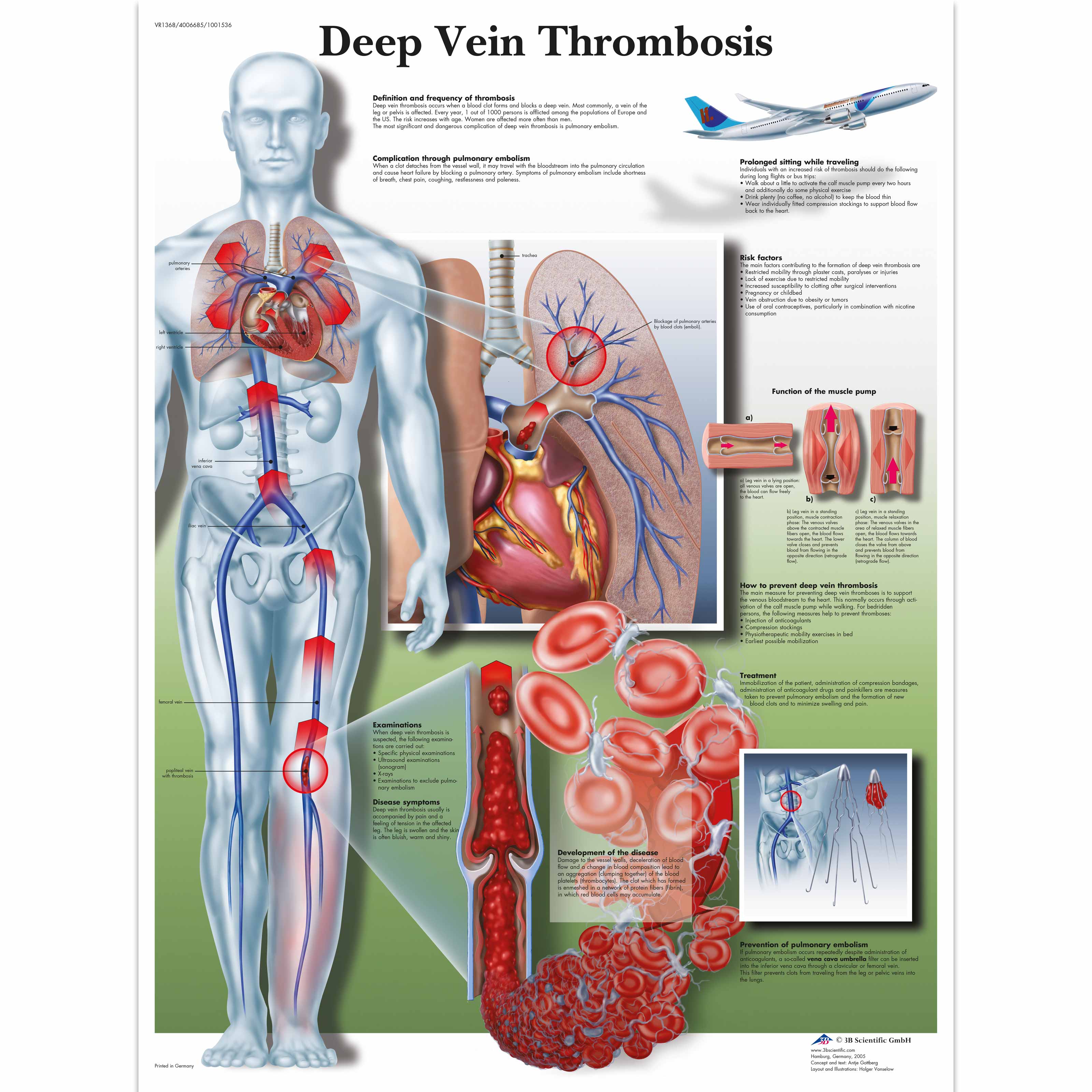 Deep Vein Thrombosis Anatomical Chart