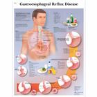 Lehrtafel - Gastroesophageal reflux disease, 1001602 [VR1711L], Verdauungssystem
