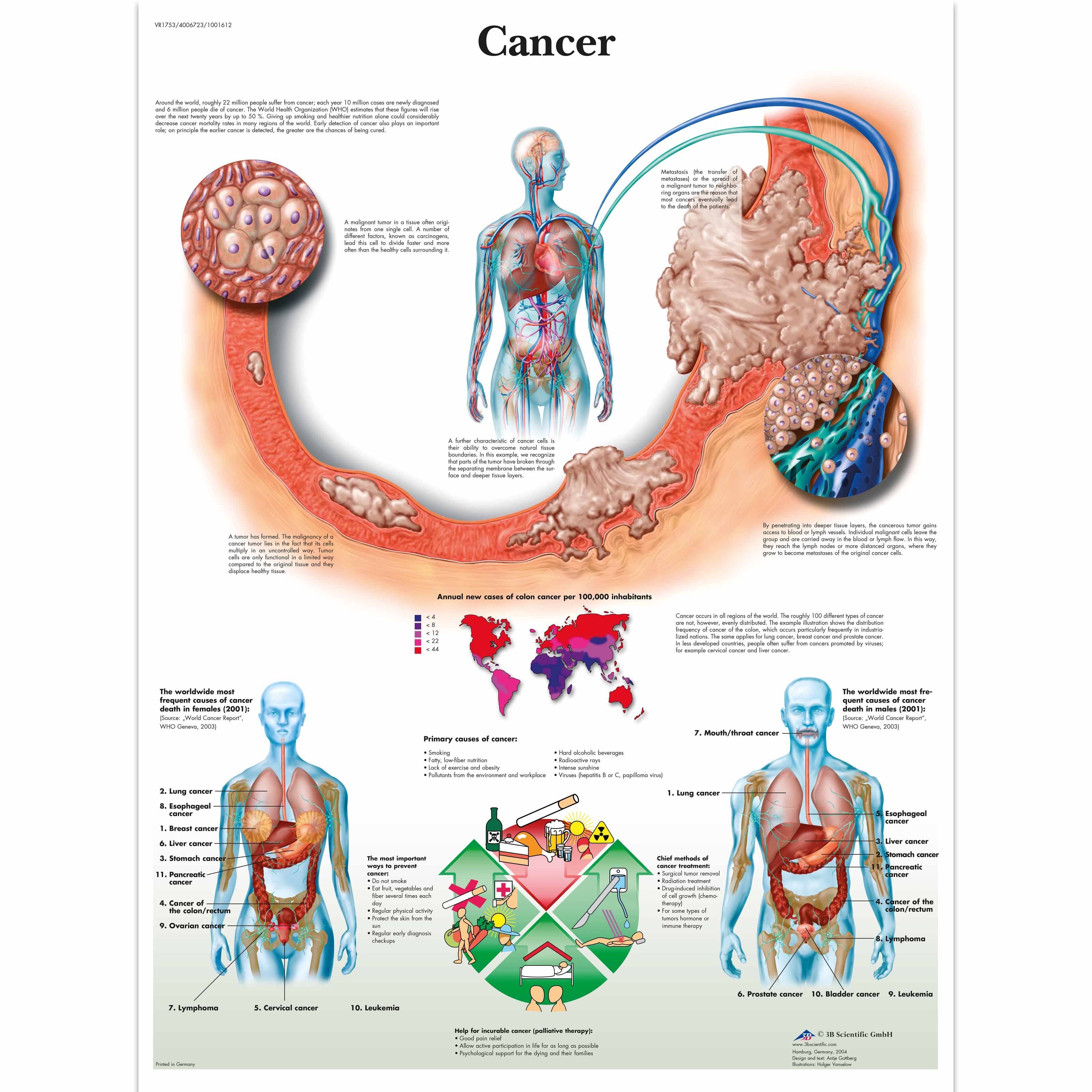 Causes Colon Cancer Chart