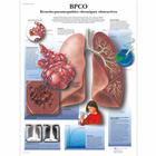 BPCO Broncho-pneumopathies chroniques obstructives, 4006761 [VR2329UU], Tobacco Education