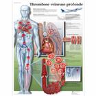 Lehrtafel - Thrombose veineuse profonde, 1001703 [VR2368L], Herz-Kreislauf-System
