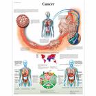 Cancer, 1001781 [VR2753L], Cânceres