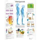 Osteoporosis, 1001803 [VR3121L], 关节炎和骨质疏松症示意图