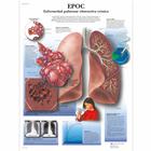 EPOC Enfermedad pulmonar obstructiva crónica, 1001851 [VR3329L], 吸烟教育示意图